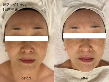 ヒビキノ バイ ヒビハンビューティー(hibikino by Hibihan Beauty)/《トーンアップ》光フェイシャル