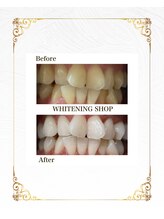 ホワイトニングショップ 葵区静岡駅店/セルフホワイトニング施術