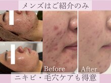 実はニキビ毛穴ケアも得意川口毛穴ハーブピーリングでお悩み改善