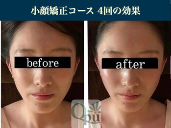 キュープ 表参道店(Qpu)/小顔矯正4回コースの変化