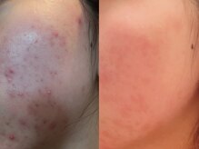 ヨサパーク ボヌール 門司駅店(YOSA PARK bonheur)/肌トラブルの原因は？60分で！