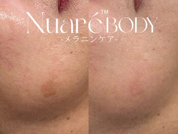 サロンドペオニー 川内店(salon de peony)の写真/長年のシミ悩みに終止符！色素沈着をケアし、気になる大きなシミを徹底改善◎