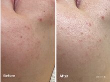 ラウレア(LAULEA)/ハーブピーリングBefore/after