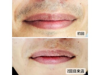 クレール 小山店(CLAIR)/【ひげ脱毛】