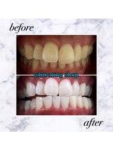 ホワイトニングショップ 岡山店/【岡山】美白ホワイトニング