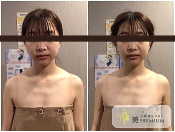 美プレミアム 越谷店/360°美顔小顔矯正｜施術結果