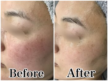 ルリアン(LeLien)/ララピール＋LDM 6回の効果！！