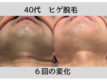 ビモア(Bmore)/★ビフォーアフター★