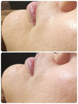 プレイス 太融寺店(PLACE)/ハーブピーリング