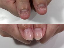 エスネイル(S-nail)/深爪矯正/自爪育成