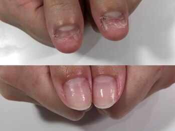 エスネイル(S-nail)/深爪矯正/自爪育成