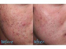 ホワイティアビシェル 浦和(Whitia Vishell)/プラズマシャワー照射ニキビケア