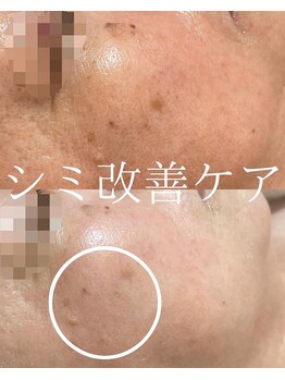 サロンディア(SALON Dea)/施術3ヶ月効果