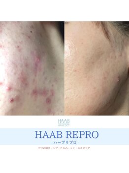 フルアナ(Hu ruana)/ハーブピーリング