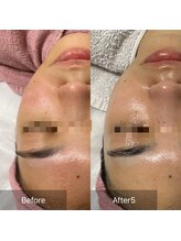 アリアサンティエ(Alia Scintiller)/毛穴、ニキビ、テカリ、赤み