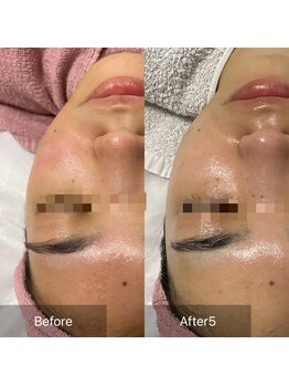 アリアサンティエ(Alia Scintiller)/毛穴、ニキビ、テカリ、赤み