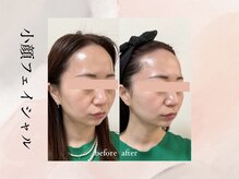 ビシア(Bicia)/小顔フェイシャル