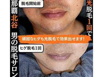 メンズディースタイル 首里店(Men's Dstyle)/那覇メンズ脱毛Before After