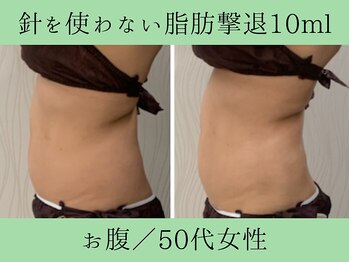 ソルニス(Solnis.)/痩身☆脂肪分解/ハイパーナイフ