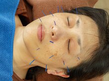 青空堂はりきゅうマッサージ院/美顔はり