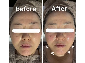 シェリー(CHERIE)の写真/年齢サインにサヨナラ!下がった顔も上向きに。効果的なリフトアップで自信を☆