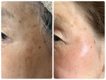 リュミエール デスポワール(Lumiere d'espoir)/ハーブピーリング