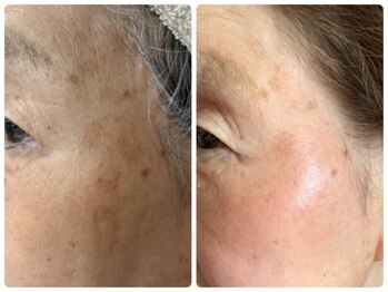 リュミエール デスポワール(Lumiere d'espoir)/ハーブピーリング