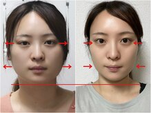 さつま骨格矯正 渋谷 恵比寿本院/歪み小顔矯正