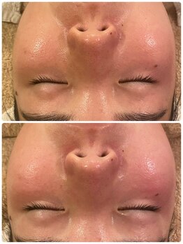 うつくし痩身 美サロン ゼットワン(Z-ONE)/ハイドロ・カーボキシー・小顔