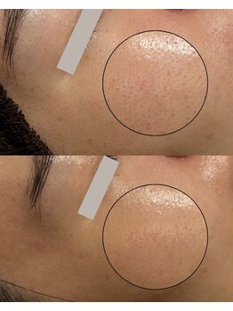 エル(Elle)/【毛穴ケア】開き/黒ずみ毛穴