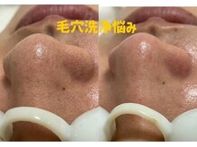 クリーン アンド ビューティーの雰囲気（長年の毛穴のつまりもスッキリ◎ハイドラ洗浄全顔！）