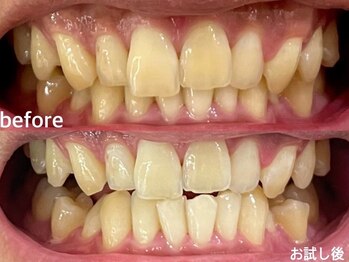 グラーティア 奈良王寺店/ホワイトニング★お試し後★