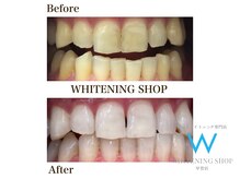 ホワイトニングショップ 甲賀店/Before&After『ホワイトニング』