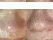 ダリア(Dahlia)/毛穴エクストラクション