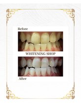 ホワイトニングショップ 葵区静岡駅店/セルフホワイトニング施術