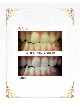 ホワイトニングショップ 葵区静岡駅店/セルフホワイトニング施術