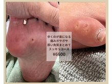 爪屋の雰囲気（痛い魚の目ガサガサかかと厚いタコまとめてスッキリコース6600円）