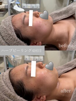 ルポアン(Repos an)/before/after
