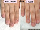 自爪育成・川崎・深爪