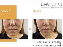 ルピエ(Lupir)/ビフォーアフター