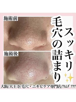 アルムダアクア 天王寺店(Aleumda AQUA)/毛穴エクストラクションプロ大阪
