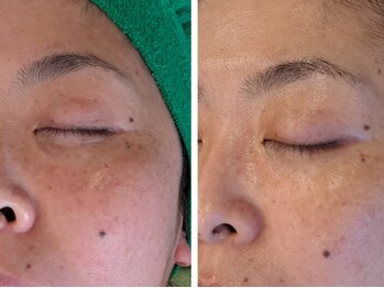 ヒツキ(hituki)/美肌ピーリングで潤いUP♪