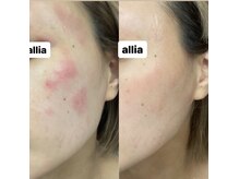 アリア(allia)の雰囲気（本気の肌質改善。敏感肌でお悩みの方もご来店頂けます。）