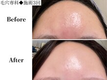 フレイヤ(FREYA)/毛穴専科Before→After
