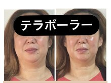 はんなりの雰囲気（【速攻小顔・リフトUPテラボーラ】 ビフォー・アフター）