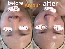 アムール(Amour)/毛穴洗浄ハイパー小顔導入