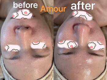 アムール(Amour)/毛穴洗浄ハイパー小顔導入