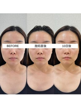 ラ クレール ビューティーサロン(LA CLAIR)/サーマリフトビフォーアフター