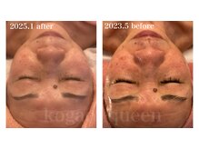 小顔クイーン 荻窪店/70歳のお客様の素晴らしい変化