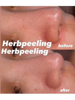 シュカ(Shuka)/ハーブピーリング